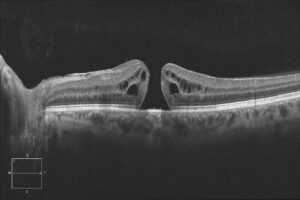 agujero macular