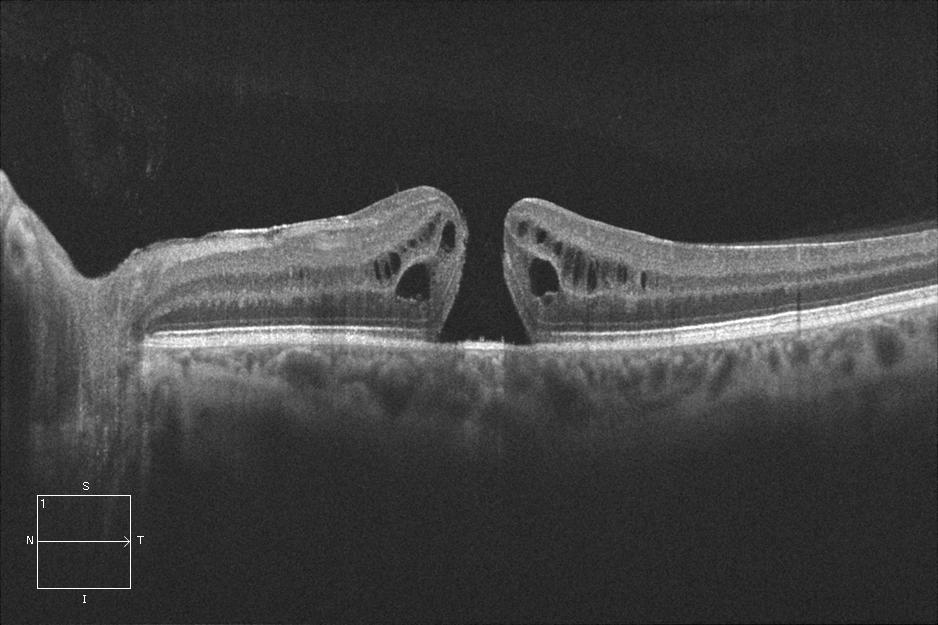 agujero macular