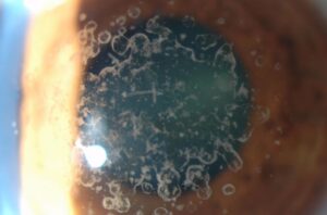 DISTROFIA GRANULAR CORNEAL