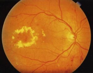 Un ojo que sufre edema macular