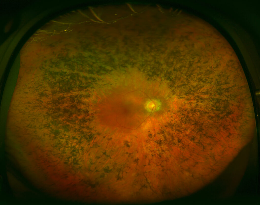 Retinosis pigmentaria