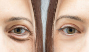 blefaroplastia