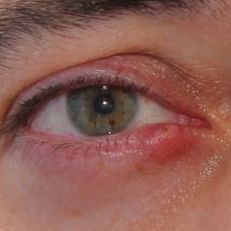 chalazion-detalle