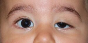 ptosis congenita