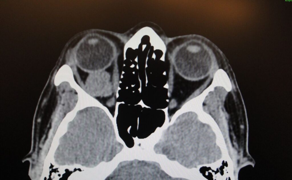 Imagen de un tumor en la órbita ocular