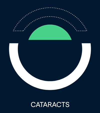 Cataracts